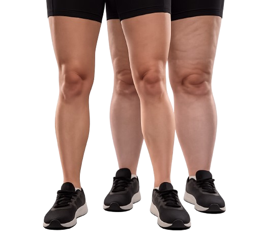 Pernas Lipedema